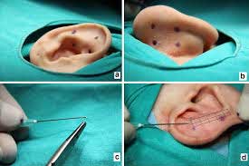 Πλαστική χειρουργική αυτιών
